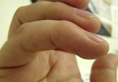 Right little finger