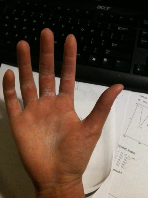 callouses.JPG callouses.JPG