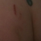 good view of fading bruises (and gratuitous amount of crack)