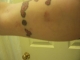 arm bruises