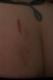 good view of fading bruises (and gratuitous amount of crack)