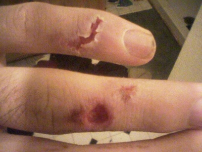 Halfway healed electric burns.jpg