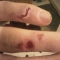 Halfway healed electric burns.jpg